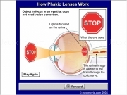 Play How phakic lenses work